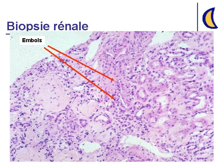 Biopsie rénale Embols 