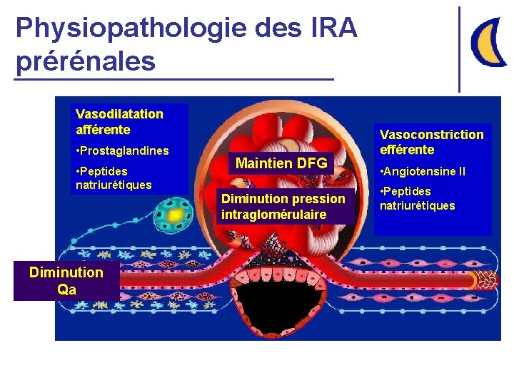 Physiopathologie des IRA prérénales Vasodilatation afférente • Prostaglandines • Peptides natriurétiques Maintien DFG Diminution