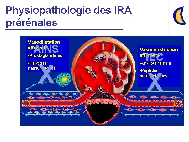 Physiopathologie des IRA prérénales Vasodilatation afférente AINS • Prostaglandines X • Peptides natriurétiques Vasoconstriction