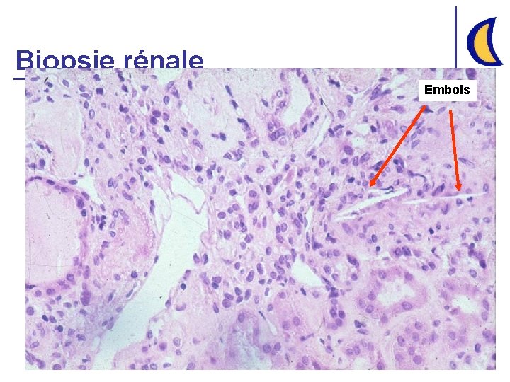 Biopsie rénale Embols 