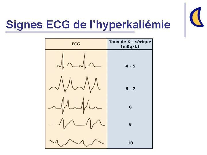 Signes ECG de l’hyperkaliémie 