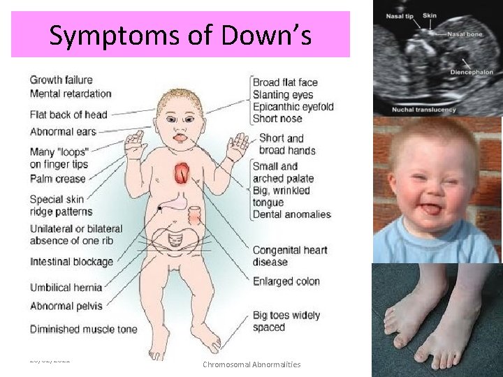 Symptoms of Down’s 28/02/2021 Mrs Smith: Ch 13: Mutations an Chromosomal Abnormalities 16 