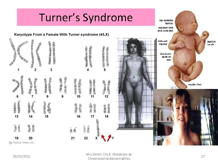 Turner’s Syndrome 28/02/2021 Mrs Smith: Ch 13: Mutations an Chromosomal Abnormalities 17 