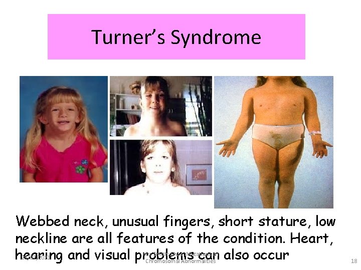 Turner’s Syndrome Webbed neck, unusual fingers, short stature, low neckline are all features of