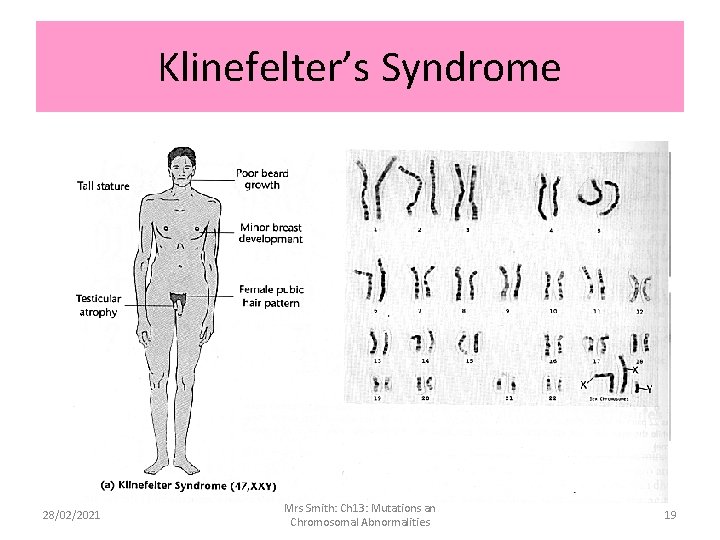 Klinefelter’s Syndrome 28/02/2021 Mrs Smith: Ch 13: Mutations an Chromosomal Abnormalities 19 