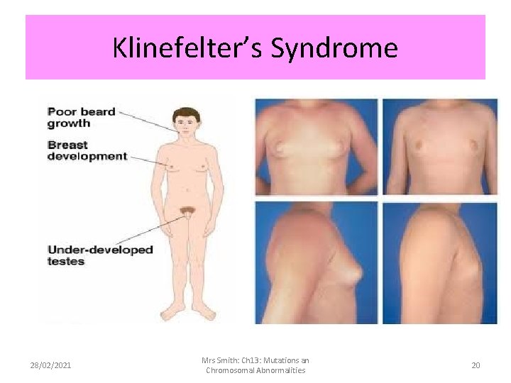 Klinefelter’s Syndrome 28/02/2021 Mrs Smith: Ch 13: Mutations an Chromosomal Abnormalities 20 