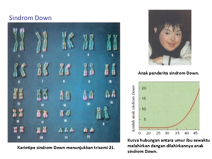 Sindrom Down Anak penderita sindrom Down. Kariotipe sindrom Down menunjukkan trisomi 21. Kurva hubungan