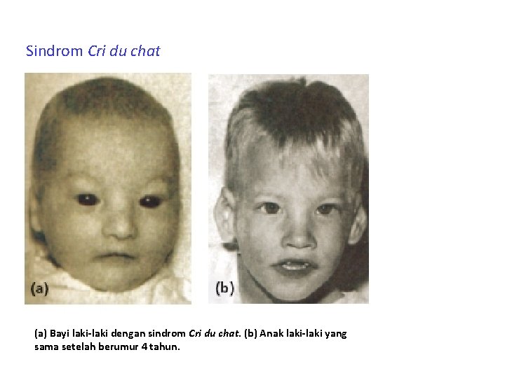 Sindrom Cri du chat (a) Bayi laki-laki dengan sindrom Cri du chat. (b) Anak