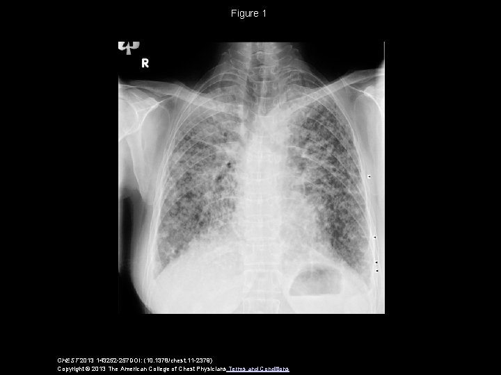Figure 1 CHEST 2013 143252 -257 DOI: (10. 1378/chest. 11 -2379) Copyright © 2013