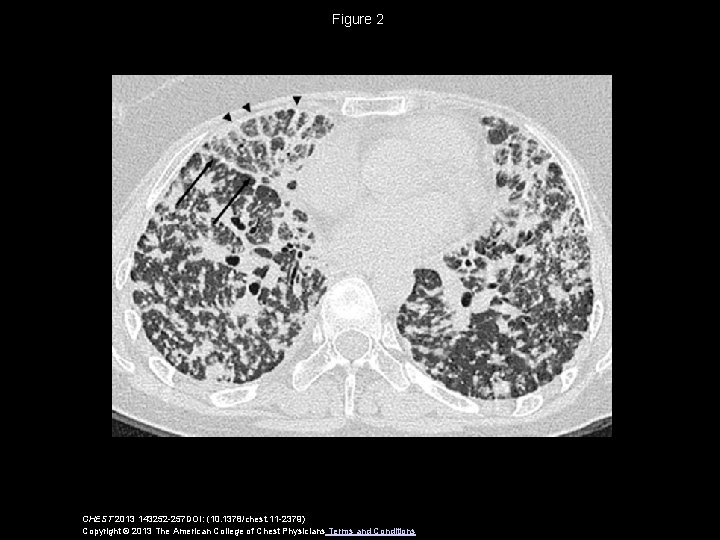 Figure 2 CHEST 2013 143252 -257 DOI: (10. 1378/chest. 11 -2379) Copyright © 2013