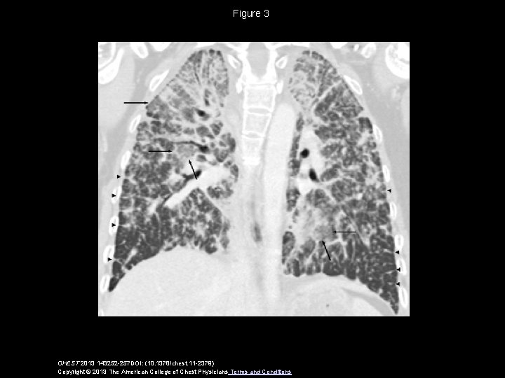 Figure 3 CHEST 2013 143252 -257 DOI: (10. 1378/chest. 11 -2379) Copyright © 2013
