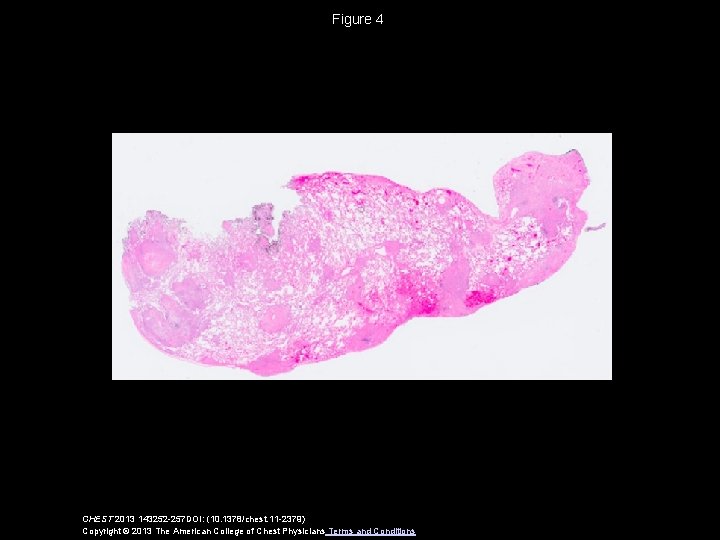 Figure 4 CHEST 2013 143252 -257 DOI: (10. 1378/chest. 11 -2379) Copyright © 2013