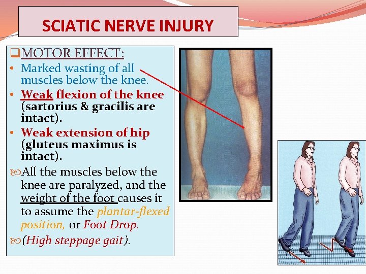 SCIATIC NERVE INJURY q. MOTOR EFFECT: • Marked wasting of all muscles below the