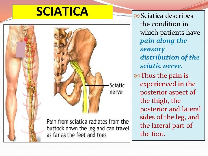 SCIATICA Sciatica describes the condition in which patients have pain along the sensory distribution