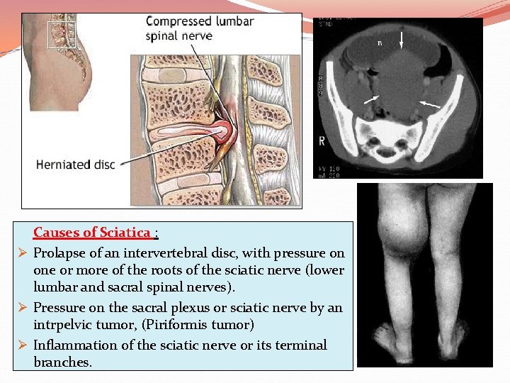 Causes of Sciatica : Ø Prolapse of an intervertebral disc, with pressure on one