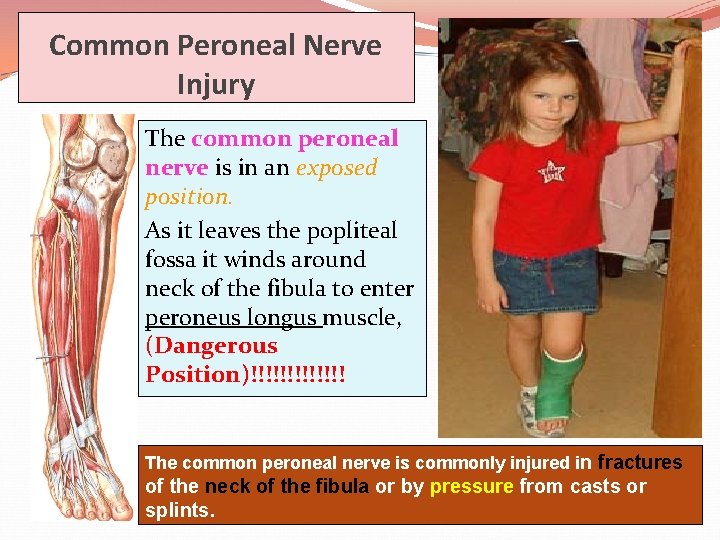 Common Peroneal Nerve Injury The common peroneal nerve is in an exposed position. As