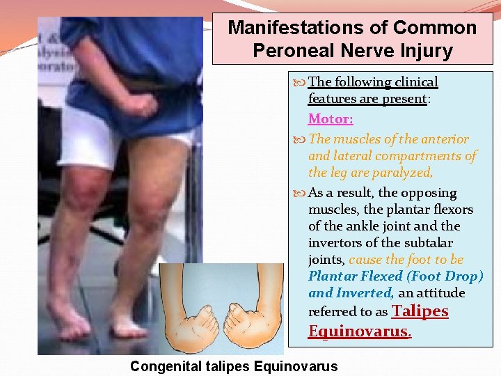 Manifestations of Common Peroneal Nerve Injury The following clinical features are present: Motor: The