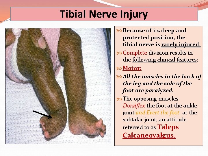 Tibial Nerve Injury Because of its deep and protected position, the tibial nerve is