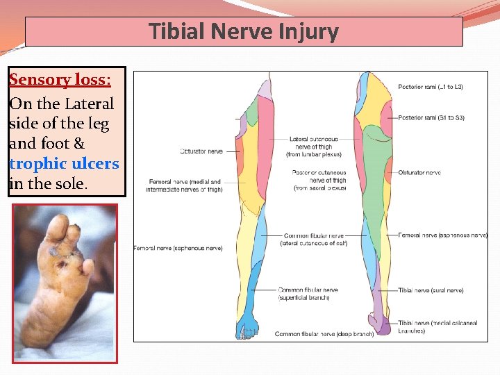 Tibial Nerve Injury Sensory loss: On the Lateral side of the leg and foot