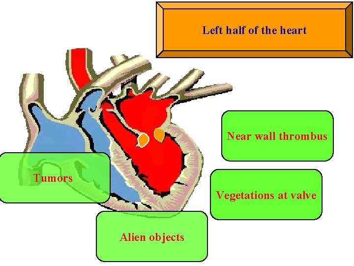 Left half of the heart Near wall thrombus Tumors БАКТЕРИАЛЬНЫЙ Vegetations at valve ЭНДОКАРДИТ