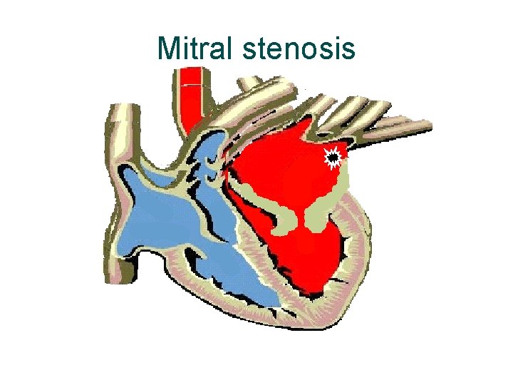 Mitral stenosis 