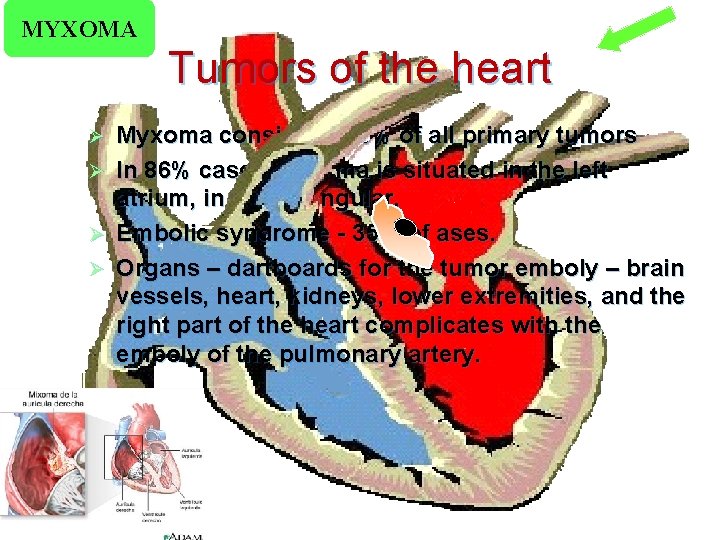 MYXOMA Tumors of the heart Ø Ø Myxoma consist 30 -50% of all primary