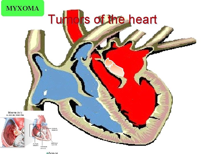 MYXOMA Tumors of the heart 