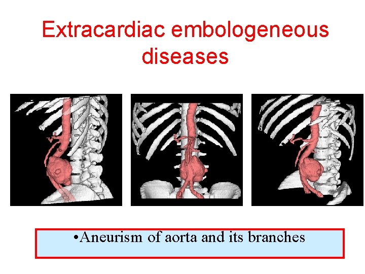 Extracardiac embologeneous diseases • Aneurism of aorta and its branches 