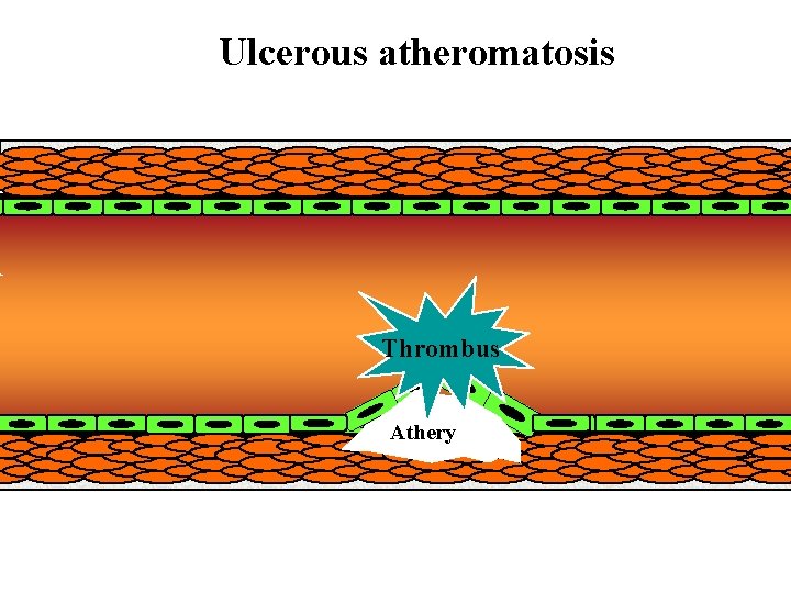 Ulcerous atheromatosis Thrombus Athery 