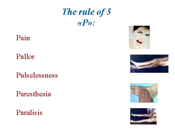 The rule of 5 «Р» : Pain Рallor Рulselessness Рaresthesia Рaralisis 
