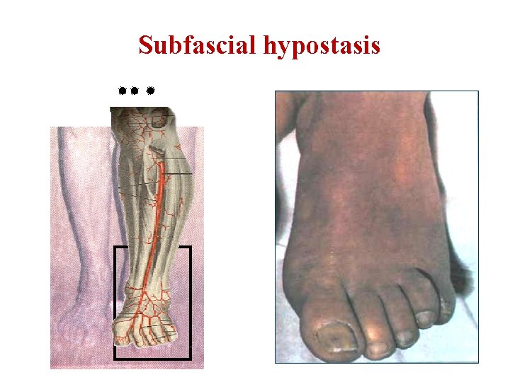 Subfascial hypostasis 