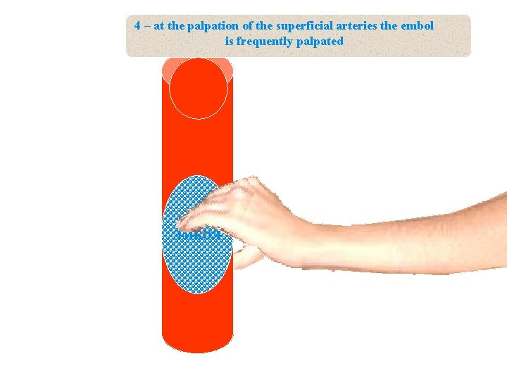 4 – at the palpation of the superficial arteries the embol is frequently palpated