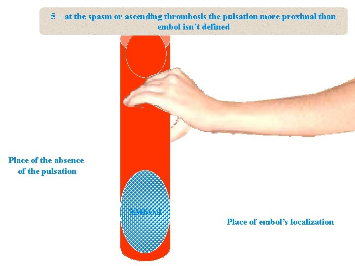 5 – at the spasm or ascending thrombosis the pulsation more proximal than embol