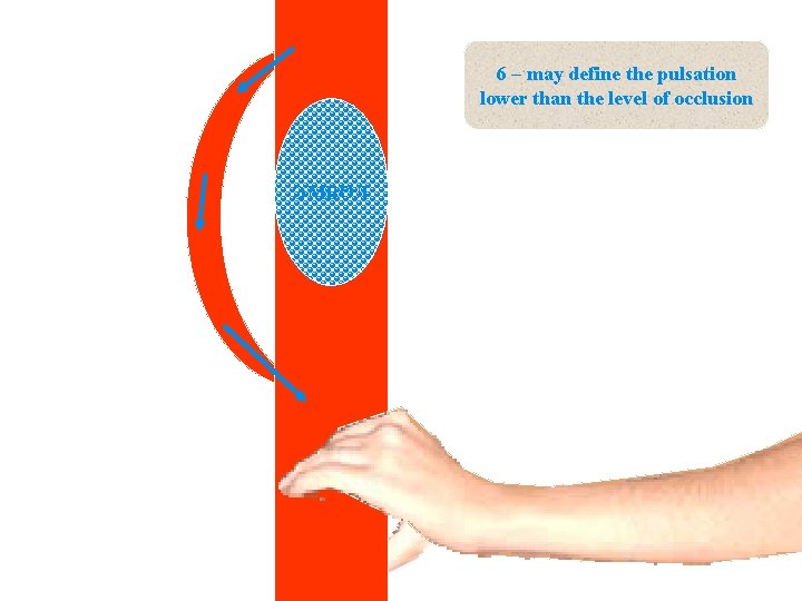6 – may define the pulsation lower than the level of occlusion ЭМБОЛ Localization