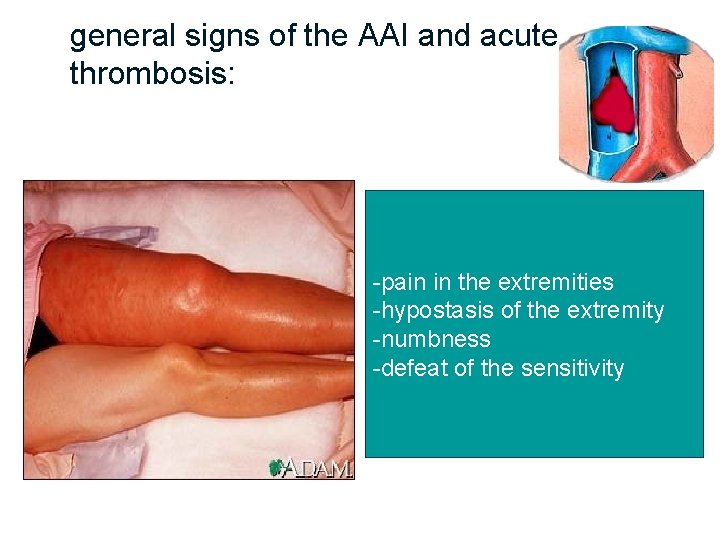  general signs of the AAI and acute venous thrombosis: -pain in the extremities