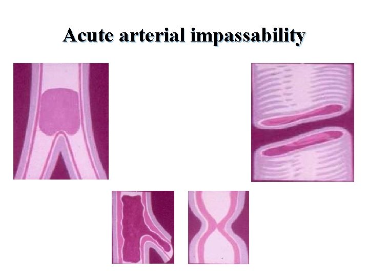 Acute arterial impassability 