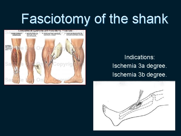 Fasciotomy of the shank Indications: Ischemia 3 а degree. Ischemia 3 b degree. 