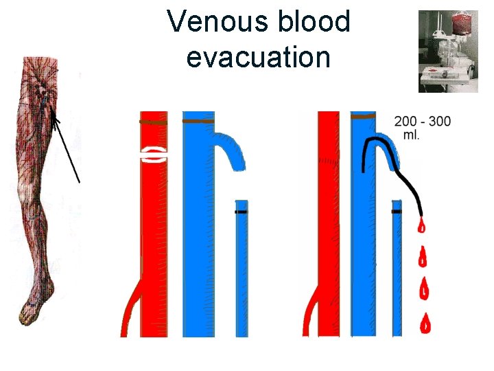 Venous blood evacuation 
