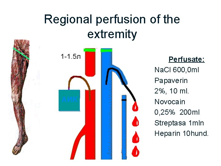 Regional perfusion of the extremity АИК Perfusate: Na. Cl 600, 0 ml Papaverin 2%,