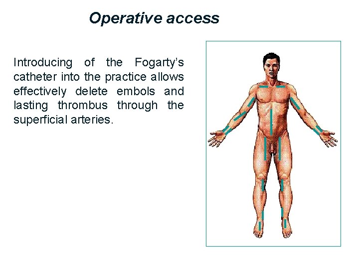 Operative access Introducing of the Fogarty’s catheter into the practice allows effectively delete embols