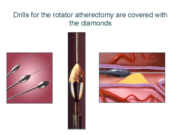 Drills for the rotator atherectomy are covered with the diamonds 