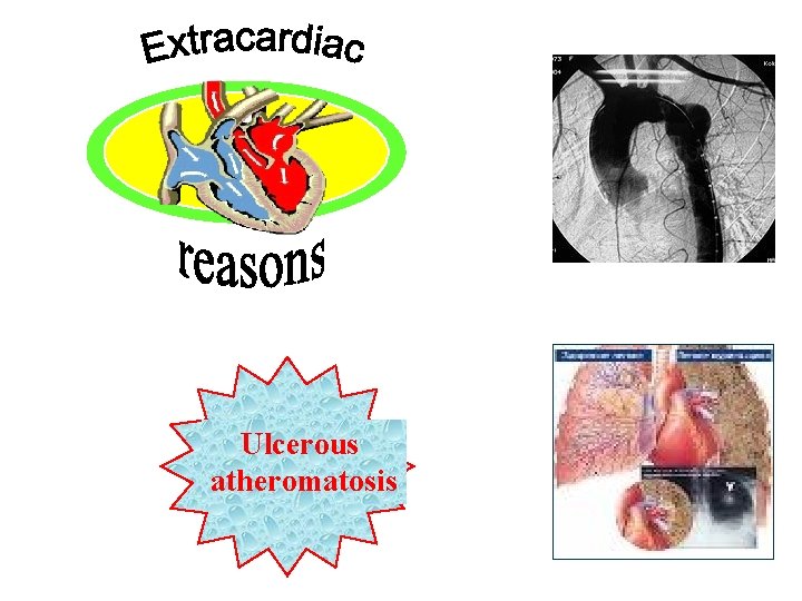 Ulcerous atheromatosis 