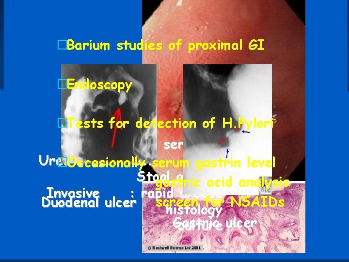 �Barium studies of proximal GI �Endoscopy �Tests for detection of H. Pylori Non invasive: