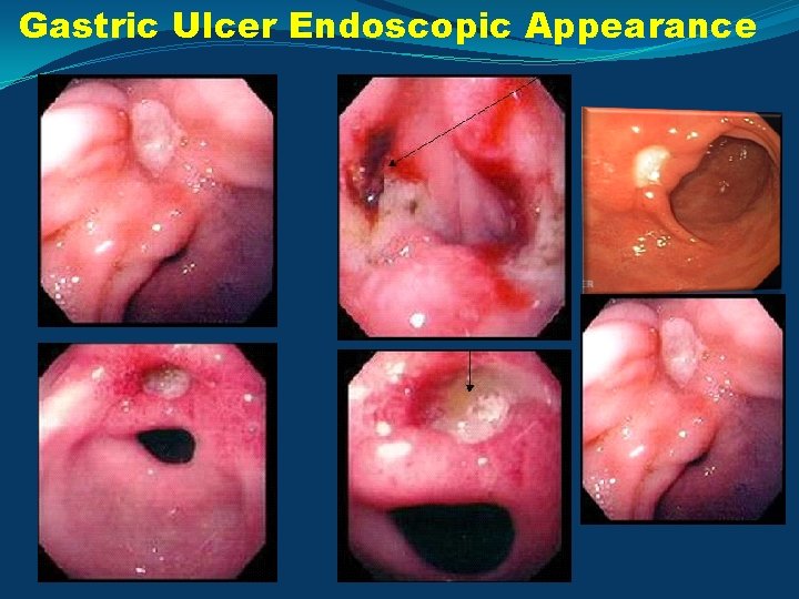 Gastric Ulcer Endoscopic Appearance 