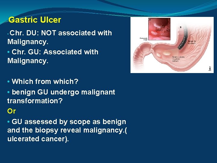 Gastric Ulcer Chr. DU: NOT associated with Malignancy. • Chr. GU: Associated with Malignancy.