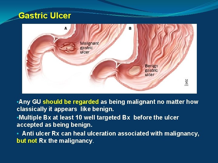 Gastric Ulcer • Any GU should be regarded as being malignant no matter how