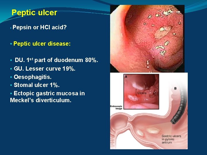 Peptic ulcer • Pepsin or HCl acid? • Peptic ulcer disease: • DU. 1