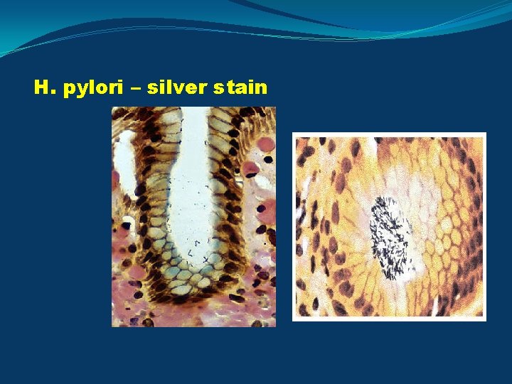 H. pylori – silver stain 