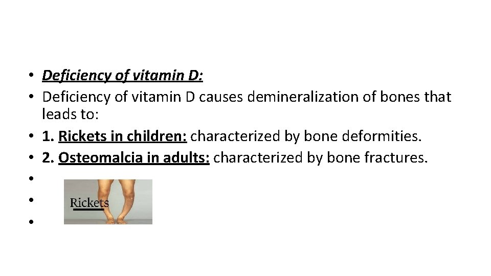  • Deficiency of vitamin D: • Deficiency of vitamin D causes demineralization of