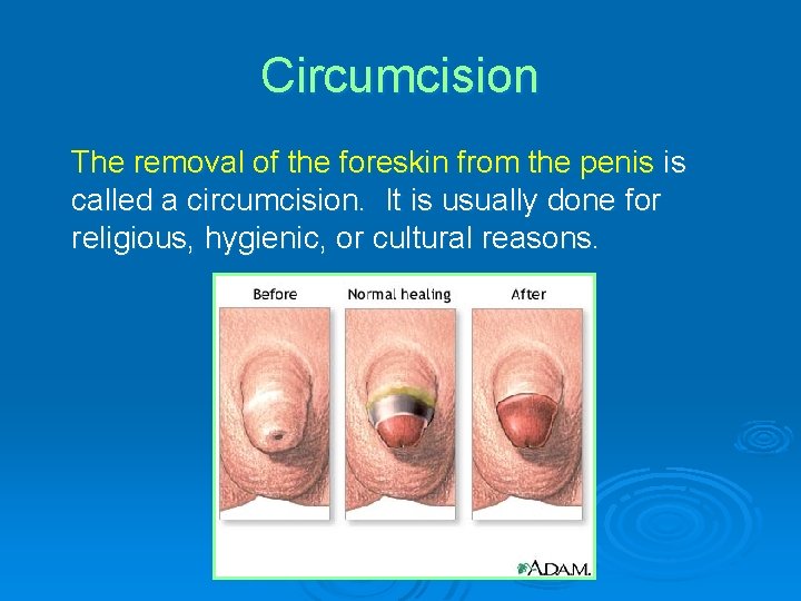 Circumcision The removal of the foreskin from the penis is called a circumcision. It